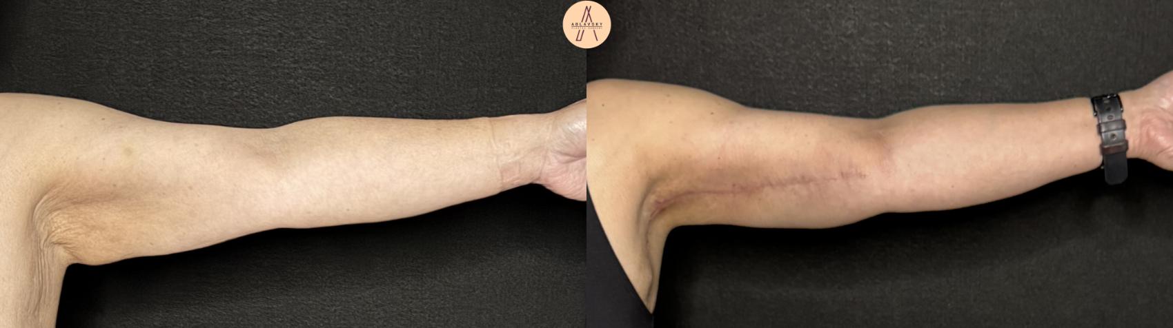 Before & After Arm Lift Case 374 Left Side View in San Antonio, Texas