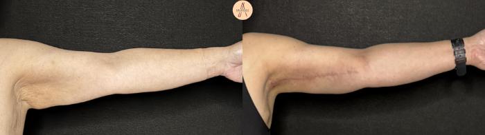 Before & After Arm Lift Case 374 Left Side View in San Antonio, Texas