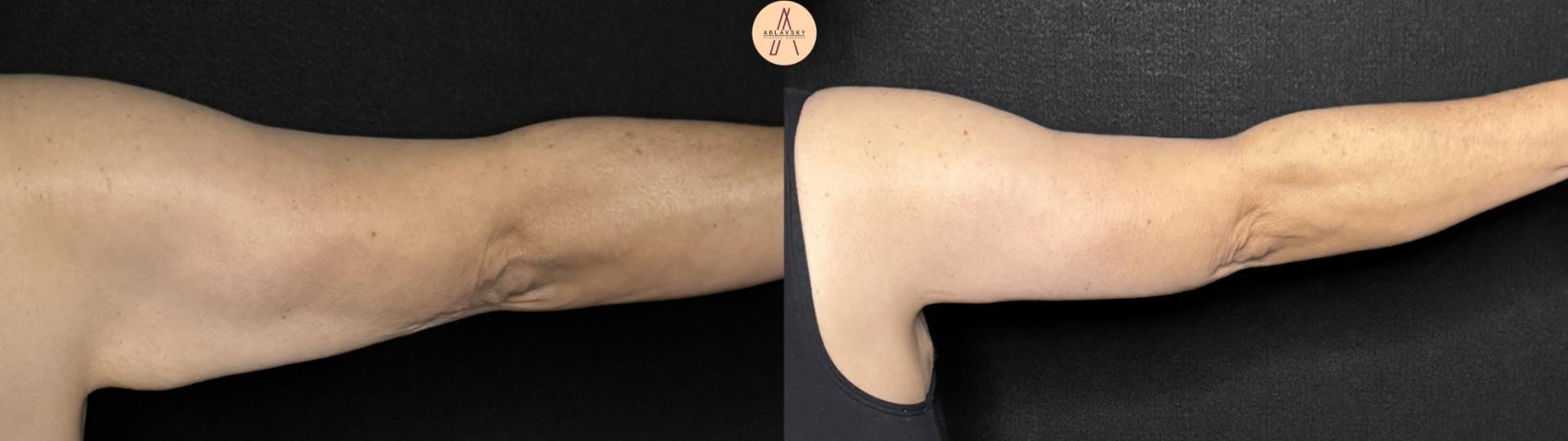 Before & After Arm Lift Case 374 Right Back View in San Antonio, Texas
