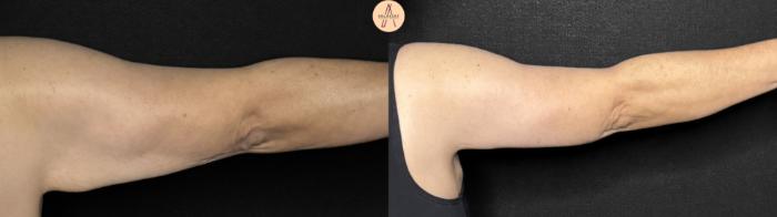 Before & After Arm Lift Case 374 Right Back View in San Antonio, Texas