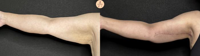 Before & After Arm Lift Case 374 Right Side View in San Antonio, Texas
