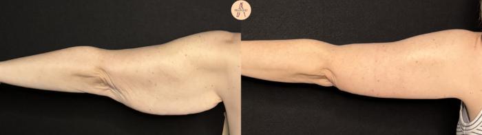 Before & After Arm Lift Case 388 Left Back View in San Antonio, Texas