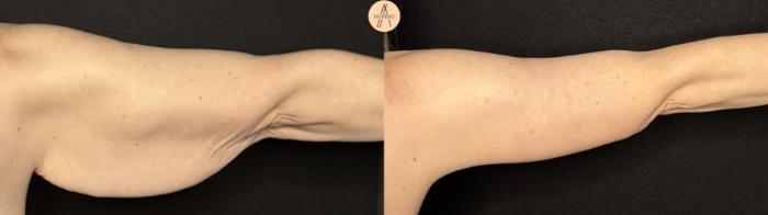 Before & After Arm Lift Case 388 Right Back View in San Antonio, Texas