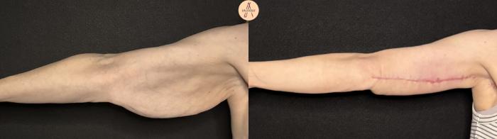 Before & After Arm Lift Case 388 Right Side View in San Antonio, Texas