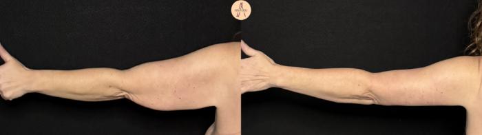 Before & After Arm Lift Case 497 Left Back View in San Antonio, Texas