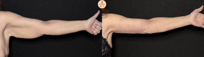 Before & After Arm Lift Case 497 Left Side View in San Antonio, Texas