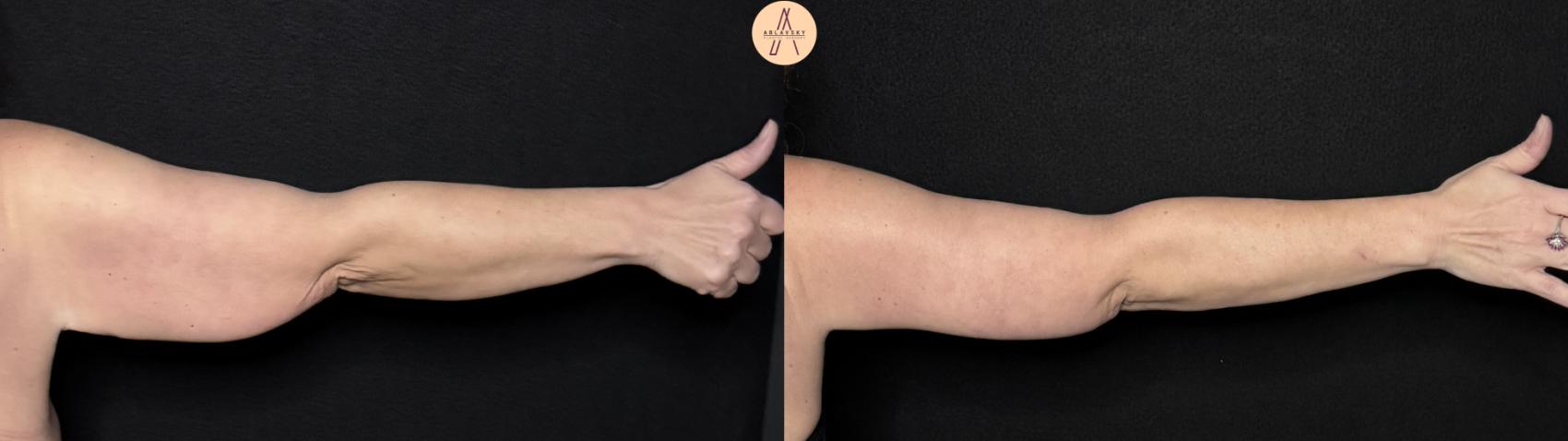 Before & After Arm Lift Case 497 Right Back View in San Antonio, Texas