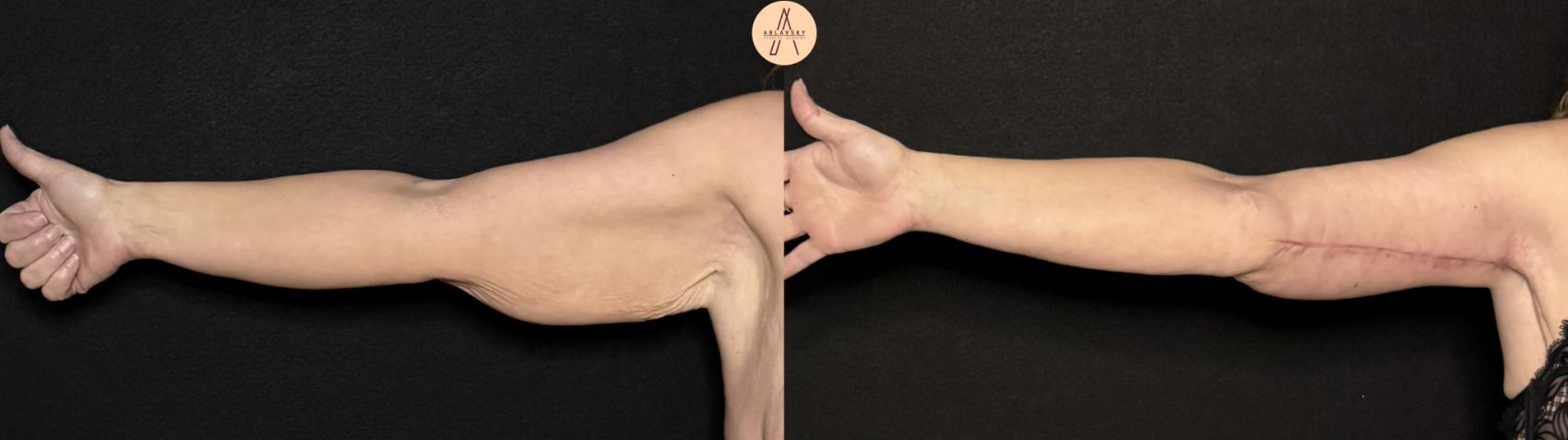 Before & After Arm Lift Case 497 Right Side View in San Antonio, Texas