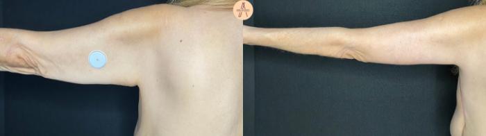 Before & After Arm Lift Case 54 Back L arm  View in San Antonio, Texas