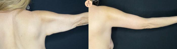 Before & After Arm Lift Case 54 Back R arm  View in San Antonio, Texas