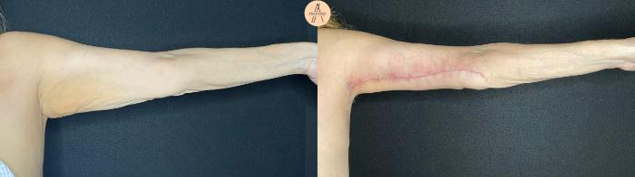 Before & After Arm Lift Case 54 Left Side View in San Antonio, Texas