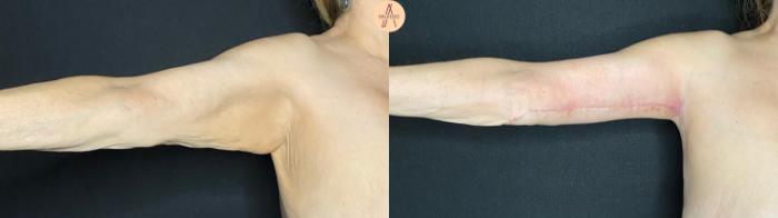 Before & After Arm Lift Case 54 Right Side View in San Antonio, Texas