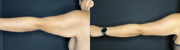 Before & After Arm Lift Case 57 Back Left arm  View in San Antonio, Texas