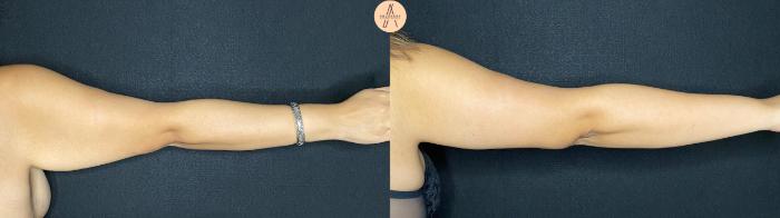 Before & After Arm Lift Case 57 Back Right arm  View in San Antonio, Texas
