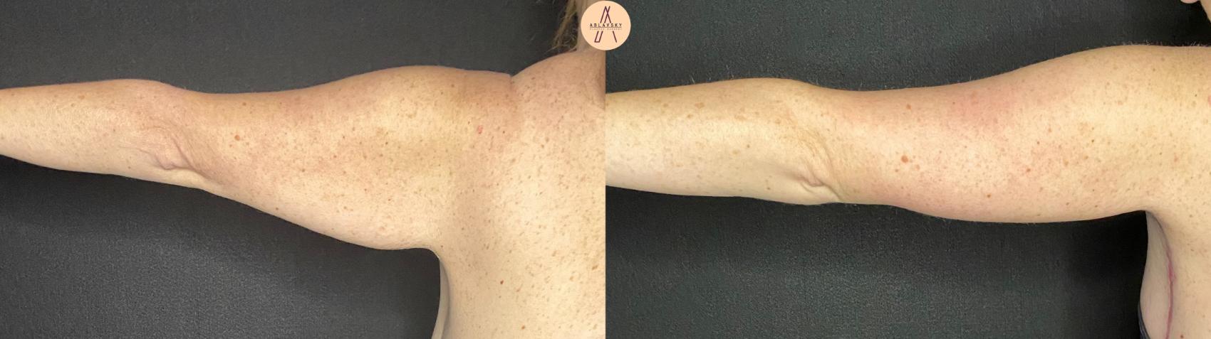 Before & After Arm Lift Case 94 Left Side View in San Antonio, Texas