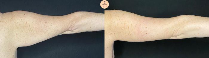 Before & After Arm Lift Case 94 Right Side View in San Antonio, Texas