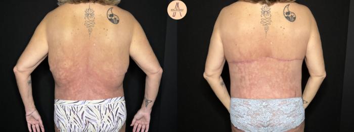 Before & After Bra line (upper back) lift Case 311 Posterior View in San Antonio, Texas