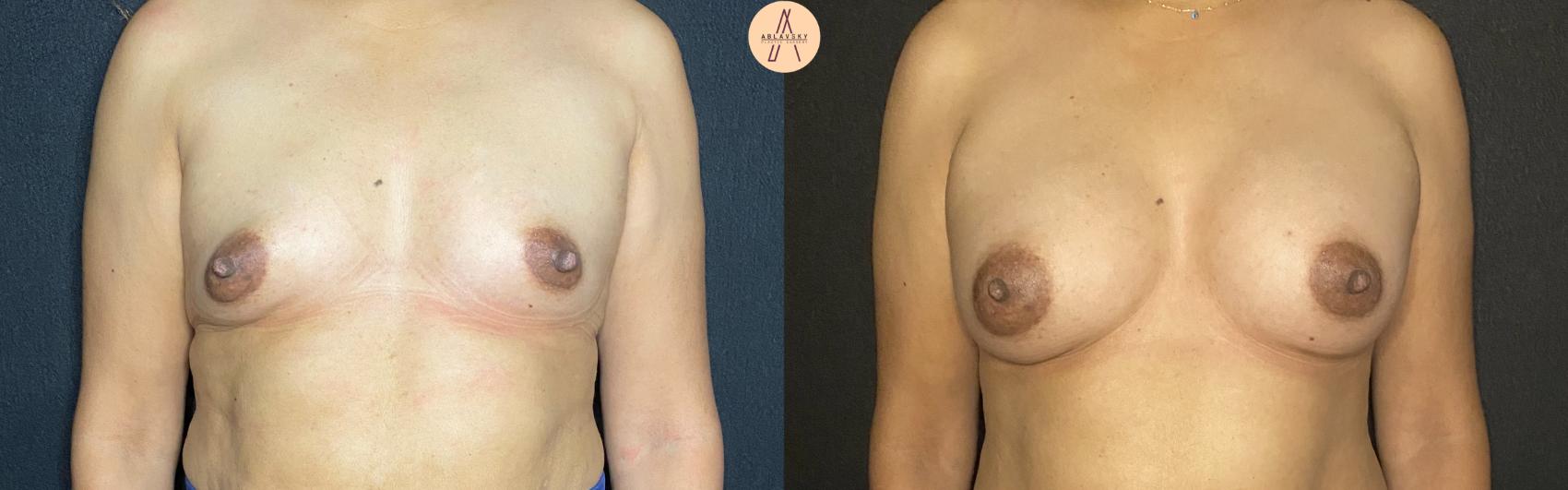 Before & After Breast Augmentation Case 102 Front View in San Antonio, Texas