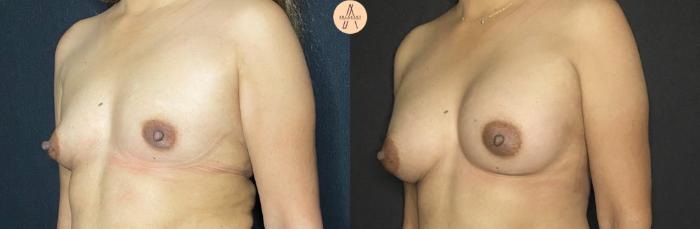 Before & After Breast Augmentation Case 102 Left Oblique View in San Antonio, Texas