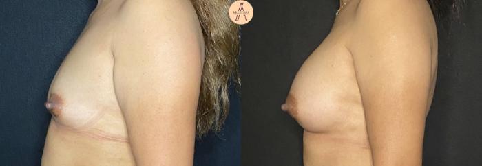 Before & After Breast Augmentation Case 102 Left Side View in San Antonio, Texas
