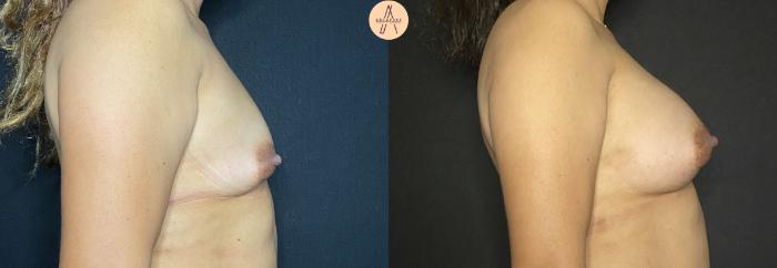 Before & After Breast Augmentation Case 102 Right Side View in San Antonio, Texas