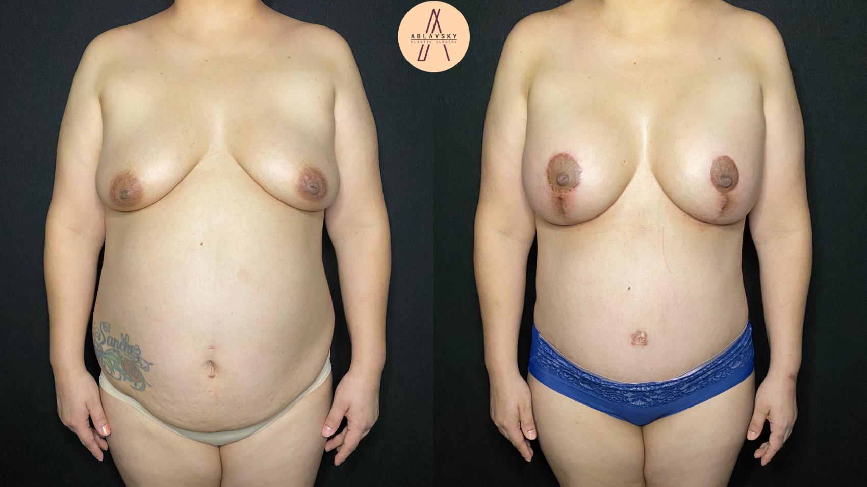 Before & After Breast Augmentation Case 108 Front View in San Antonio, Texas