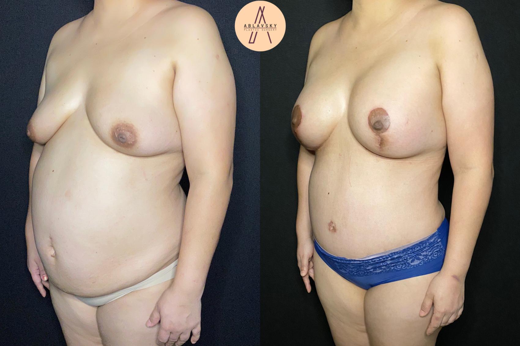 Before & After Breast Lift Case 108 Left Oblique View in San Antonio, Texas