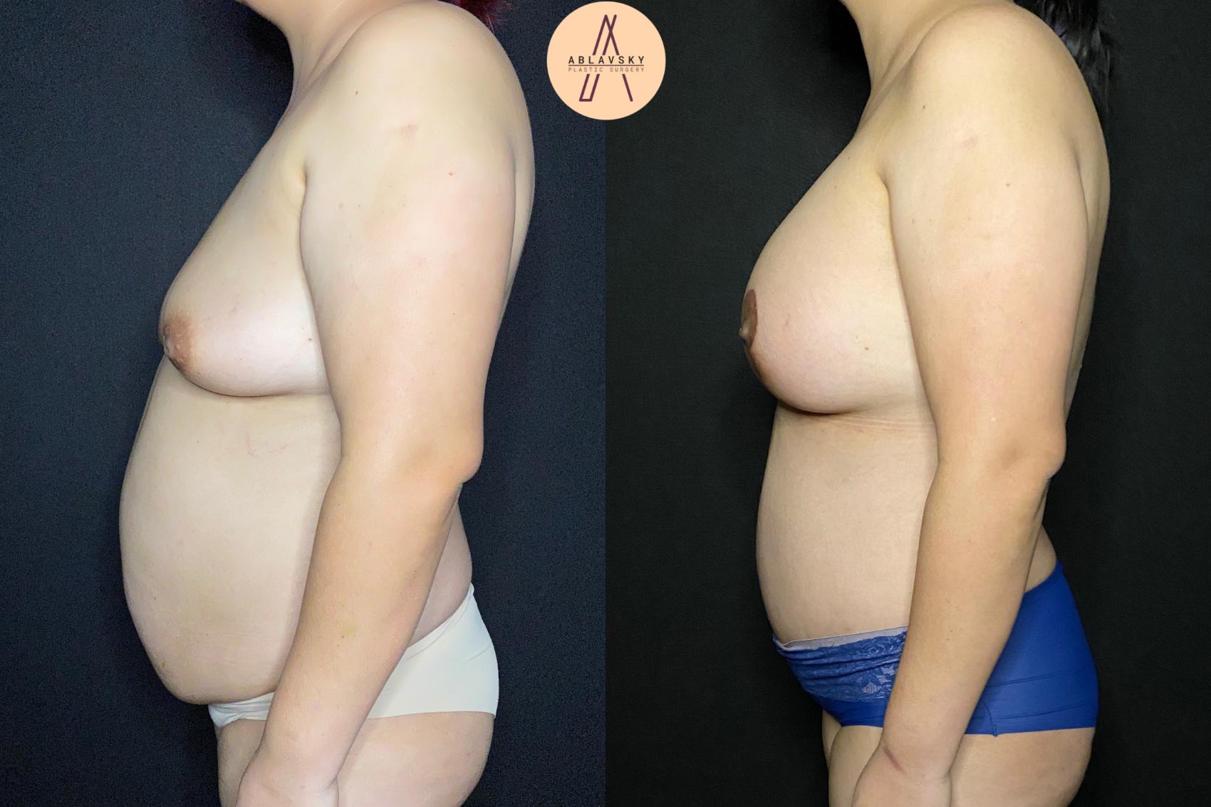 Before & After Breast Lift Case 108 Left Side View in San Antonio, Texas