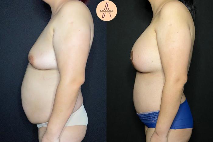 Before & After Breast Augmentation Case 108 Left Side View in San Antonio, Texas