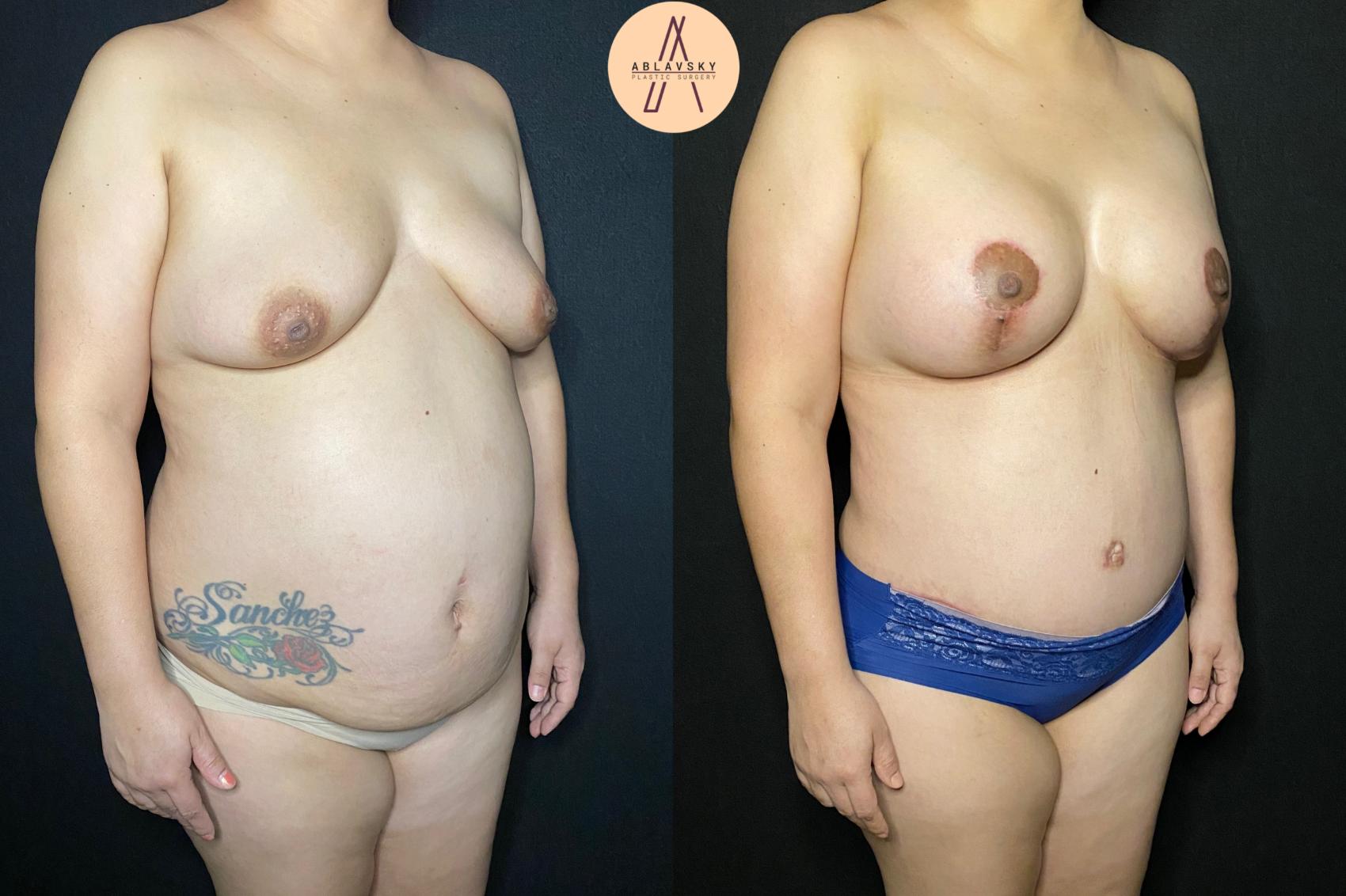 Before & After Breast Lift Case 108 Right Oblique View in San Antonio, Texas