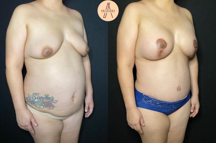 Before & After Breast Augmentation Case 108 Right Oblique View in San Antonio, Texas