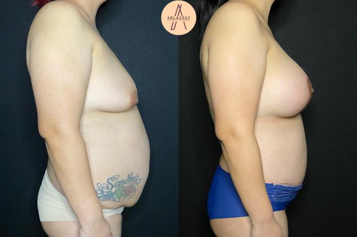 Before & After Breast Augmentation Case 108 Right Side View in San Antonio, Texas