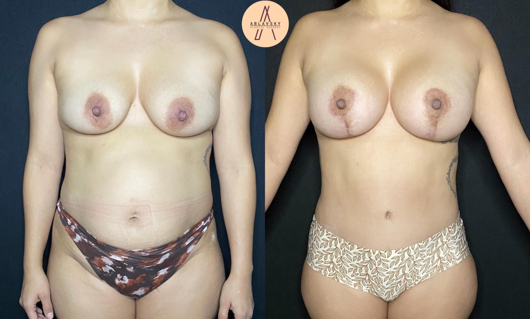 Before & After Breast Augmentation Case 112 Front View in San Antonio, Texas