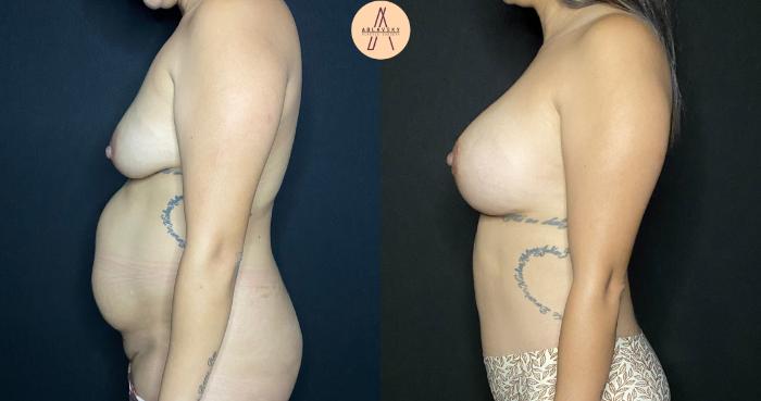 Before & After Tummy Tuck Case 112 Left Side View in San Antonio, Texas