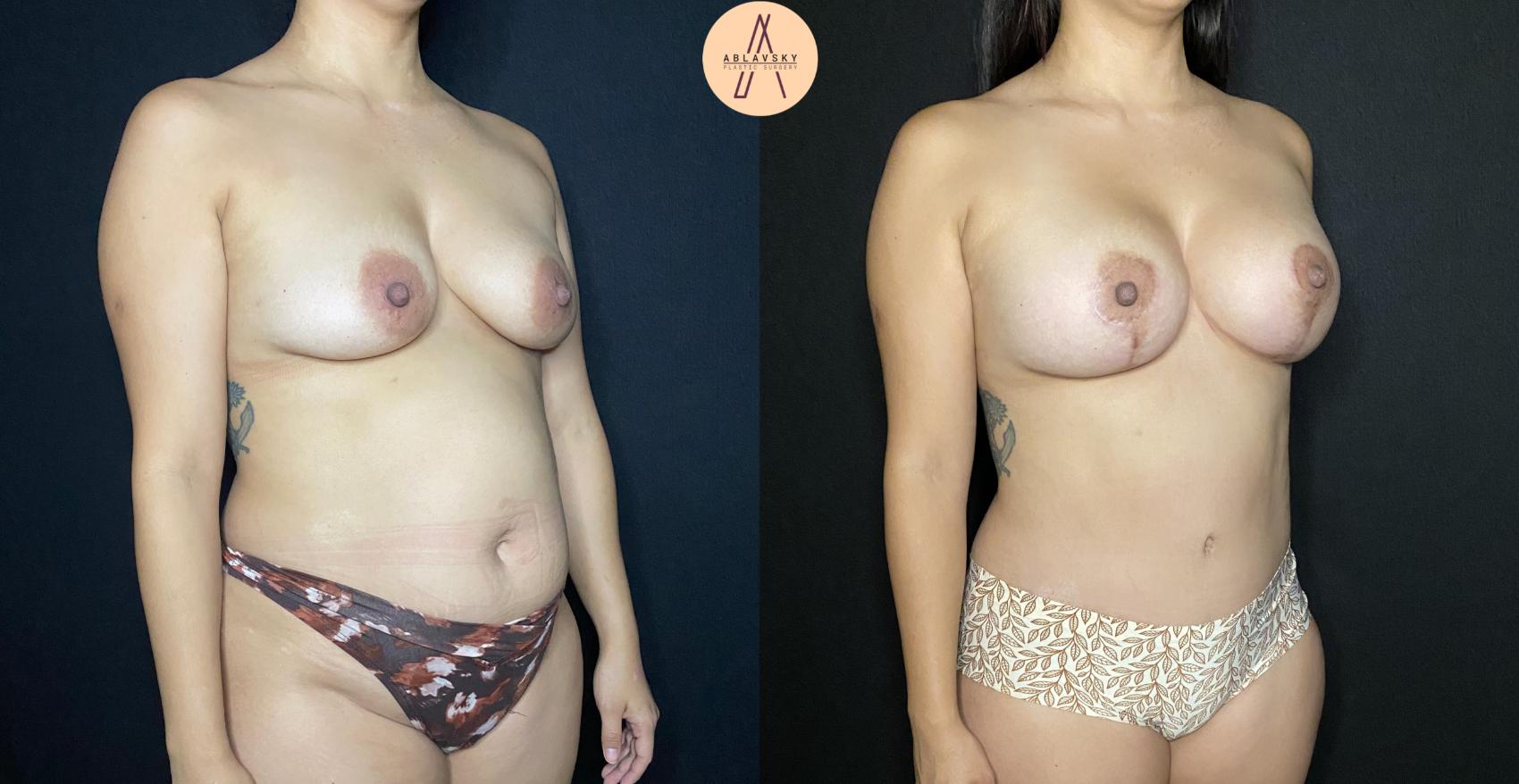 Before & After Breast Augmentation Case 112 Right Oblique View in San Antonio, Texas