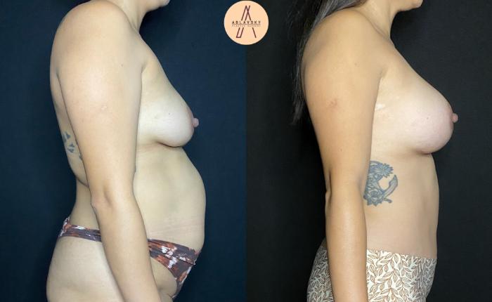 Before & After Tummy Tuck Case 112 Right Side View in San Antonio, Texas