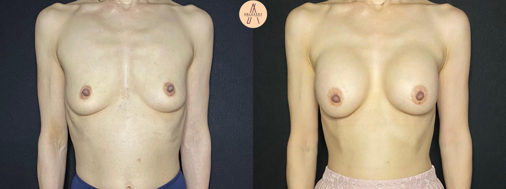 Before & After Breast Augmentation Case 121 Front View in San Antonio, Texas