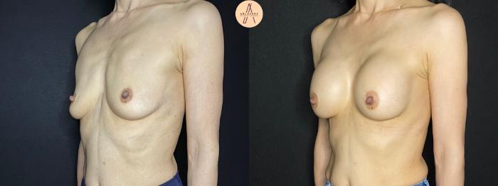 Before & After Breast Augmentation Case 121 Left Oblique View in San Antonio, Texas
