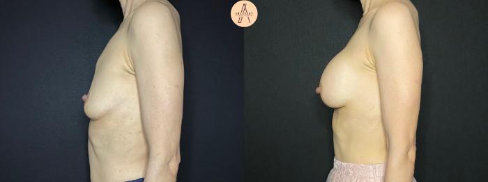 Before & After Breast Augmentation Case 121 Left Side View in San Antonio, Texas