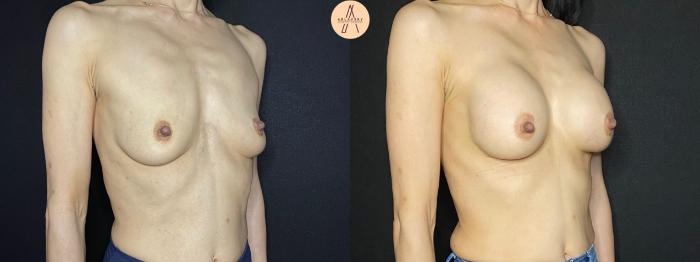 Before & After Breast Augmentation Case 121 Right Oblique View in San Antonio, Texas