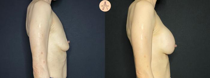 Before & After Breast Augmentation Case 121 Right Side View in San Antonio, Texas