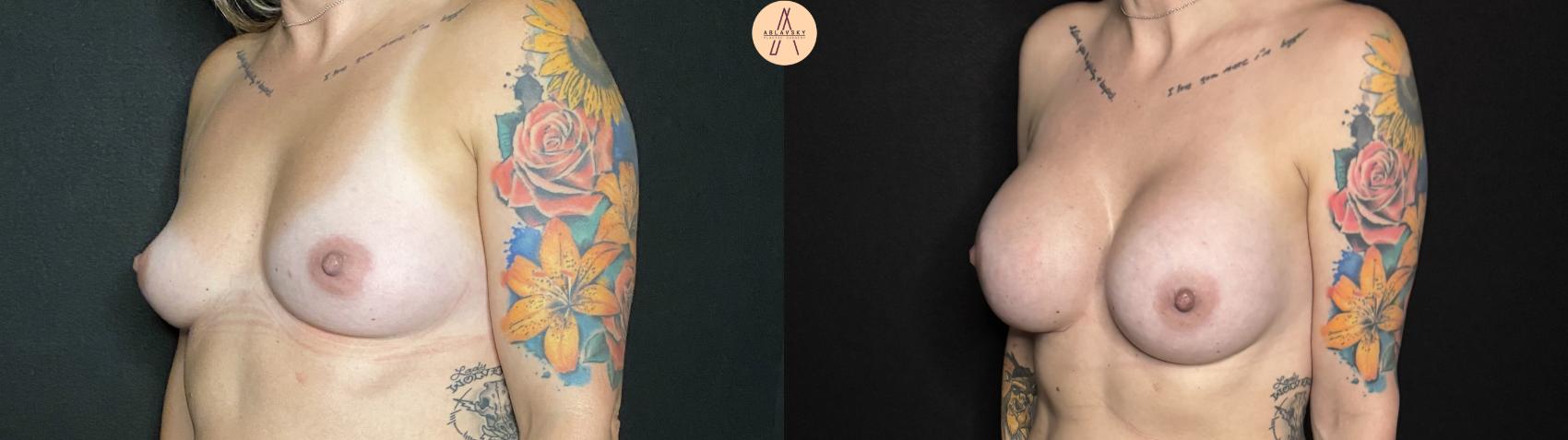 Before & After Breast Augmentation Case 133 Left Oblique View in San Antonio, Texas