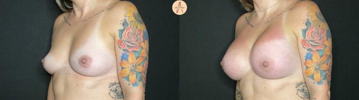 Before & After Breast Augmentation Case 133 Left Oblique View in San Antonio, Texas
