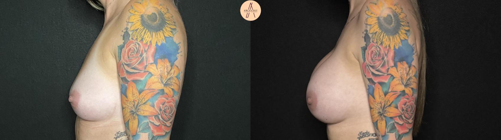 Before & After Breast Augmentation Case 133 Left Side View in San Antonio, Texas