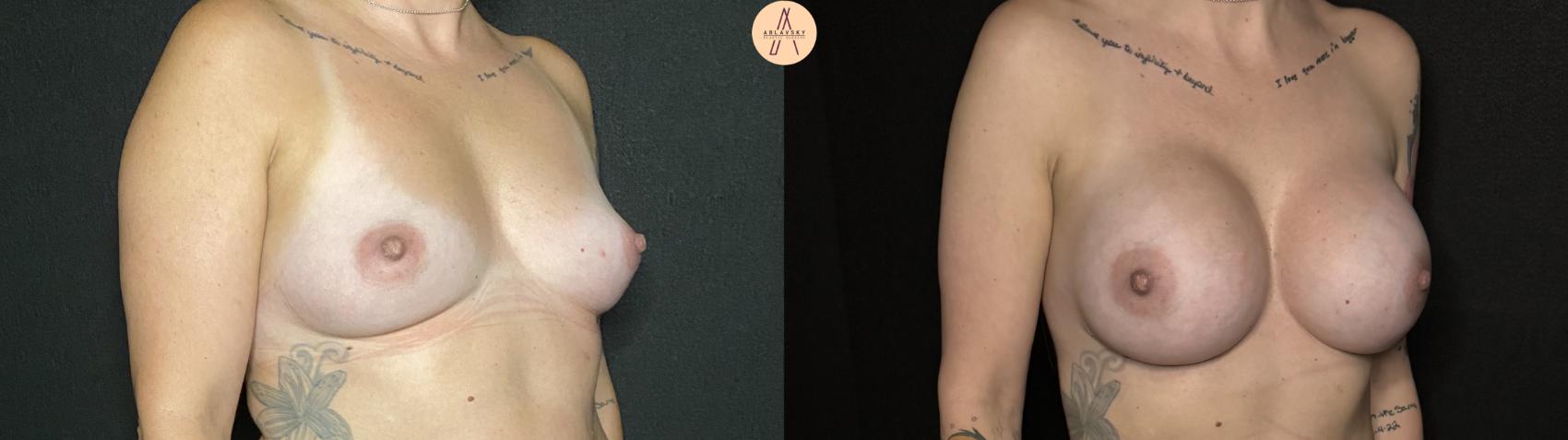 Before & After Breast Augmentation Case 133 Right Oblique View in San Antonio, Texas