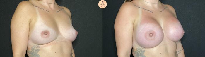 Before & After Breast Augmentation Case 133 Right Oblique View in San Antonio, Texas