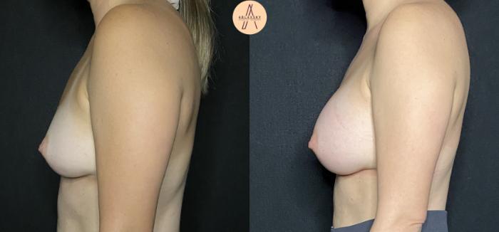 Before & After Breast Augmentation Case 144 Left Side View in San Antonio, Texas