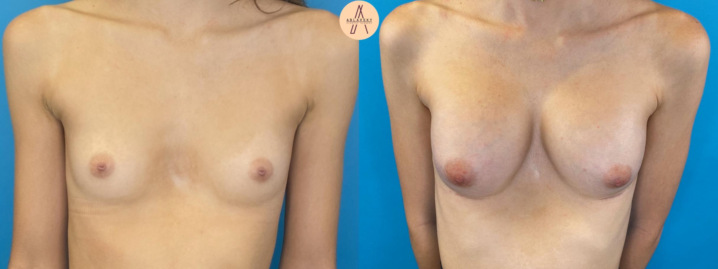 Before & After Breast Augmentation Case 15 Front View in San Antonio, Texas