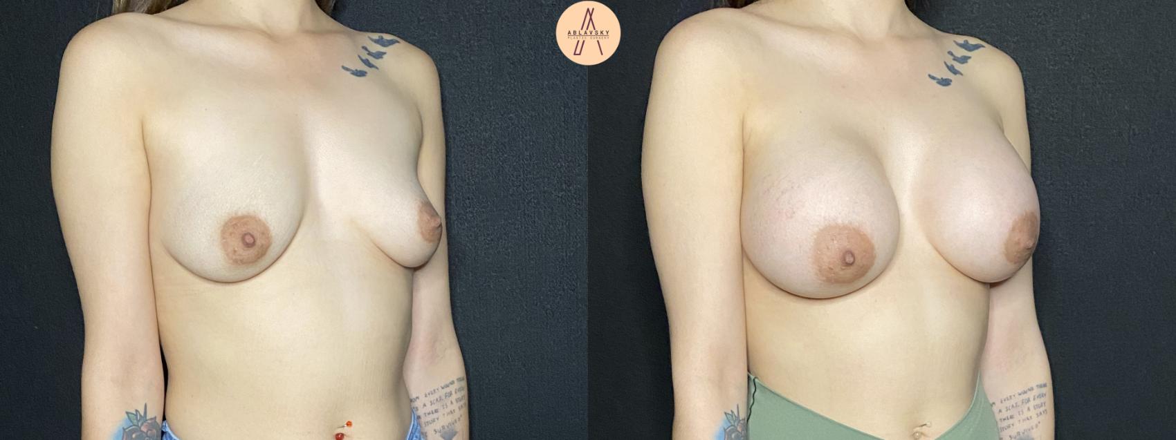 Before & After Breast Augmentation Case 167 Right Oblique View in San Antonio, Texas