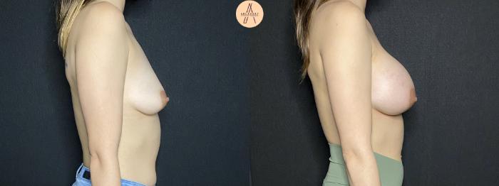 Before & After Breast Augmentation Case 167 Right Side View in San Antonio, Texas